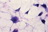 New C. difficile guidelines recommend fecal microbiota transplants
